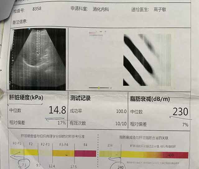 河南哪个肝硬化医院好?郑州哪个医院肝病科好