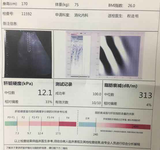 郑州那家医院看肝硬化好?河南好治疗肝硬化的医院