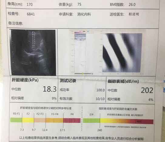 郑州那家医院看肝硬化好?河南好治疗肝硬化的医院