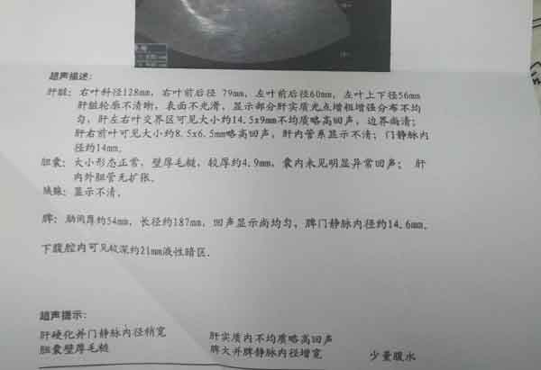 河南省治疗肝硬化综合医院?郑州看肝硬化哪家医院好
