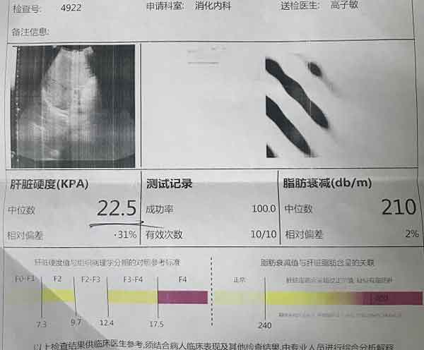 肝硬化医院|郑州那个医院治疗肝硬化好