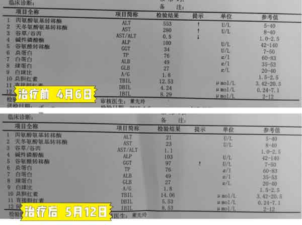 [王茂汇主任康复案例]一个月清除高达4亿的病毒、大三阳转小三阳