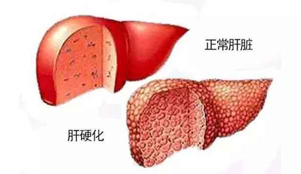 [王茂汇主任康复案例]一个月清除高达4亿的病毒、大三阳转小三阳