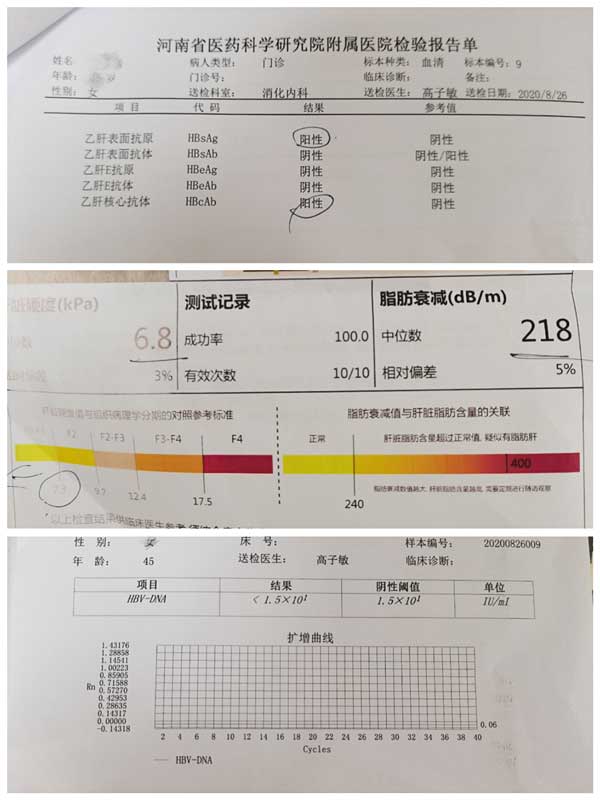 [高子敏主任案例分享]20多年乙肝病史,治疗后基本已达到停药标准!