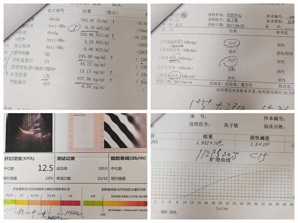 [高子敏主任案例分享]20多年乙肝病史,治疗后基本已达到停药标准!