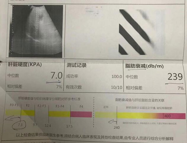 郑州哪家治肝硬化的医院好